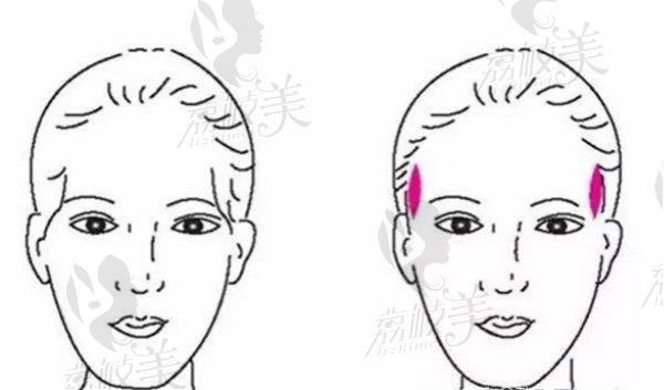 太阳穴凹陷示意图