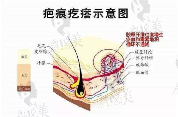 上海疤痕修复有哪些正规医院，上海正璞和上海健桥哪个治疗疤痕疙瘩技术好?