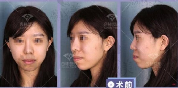 朱石江医生正颌手术：上下颌骨前突矫正术前