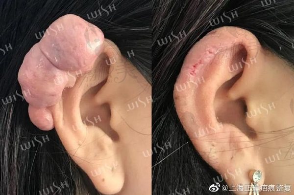 上海正璞耳廓疤痕疙瘩治疗