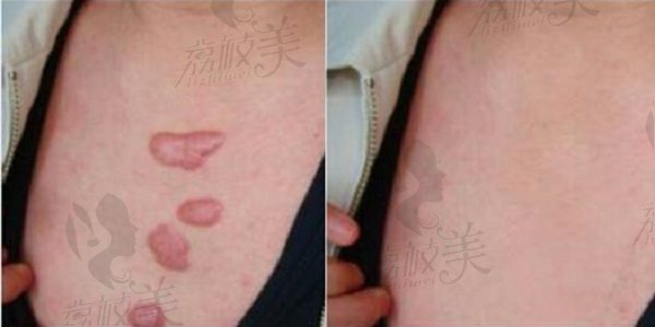 上海健桥治疗疤痕疙瘩效果对比图