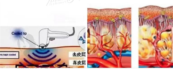 热拉提plus作用皮肤深层