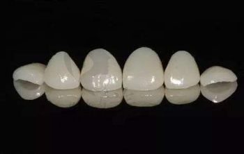牙齿瓷贴面选哪个好？琥珀瓷、蓝瓷、水晶瓷有什么区别？