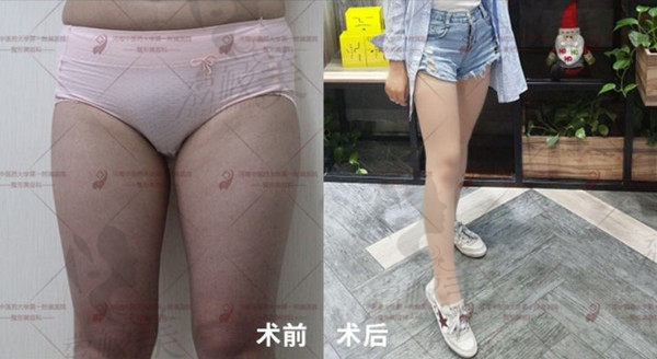 河南中医药大学附属医院美容科大腿吸脂术后效果