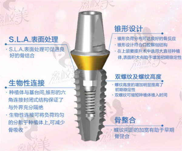 登腾种植牙特点