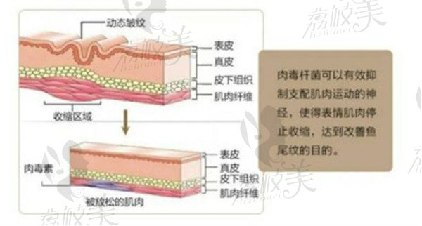 注射除川字纹