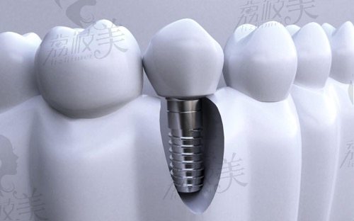 牙齿缺失的修复方式种植牙