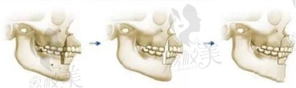 下颌后缩要做正颌还是颏成型，正颌和颏成型有什么区别？