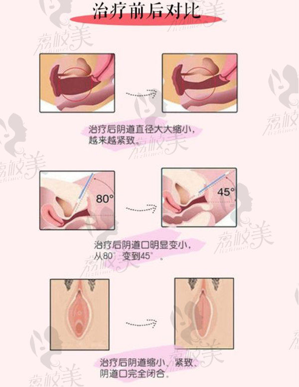 菲蜜丽抵抗老龄化治疗前后对比