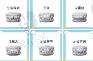 儿童需要牙齿矫正的六种情况