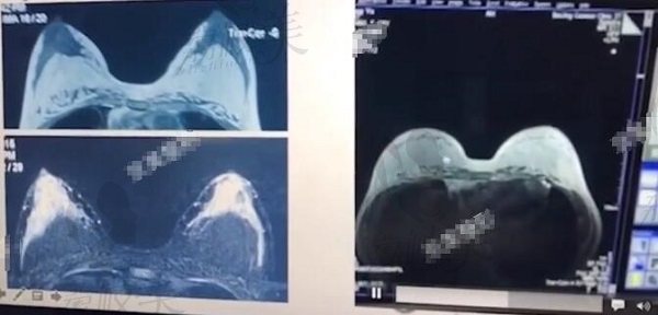 整友自体脂肪隆胸10年后做核磁检查胸部的映像