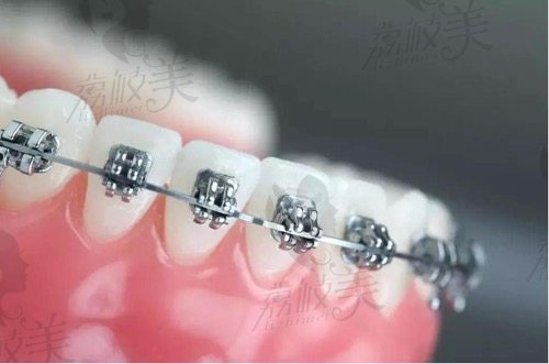 金属自锁牙套和传统牙套的区别