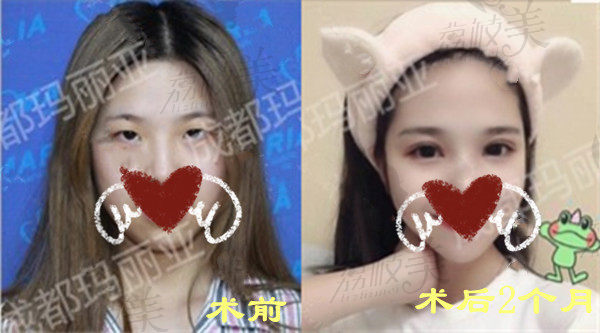 成都玛丽亚王建平双眼皮术后2个月