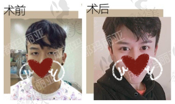 成都玛丽亚王建平双眼皮术后3个月