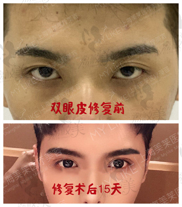 上海美莱双眼皮修复术后效果