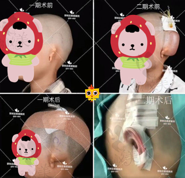 西安国医郭树忠耳再造恢复过程