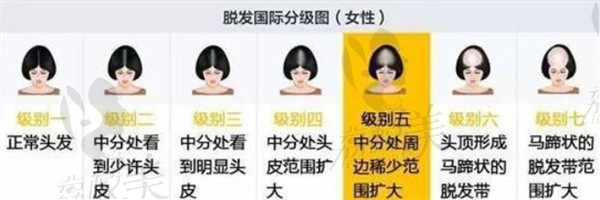 女性脱发等级分类简介