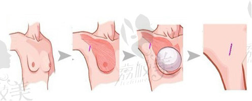 假体隆胸手术流程图