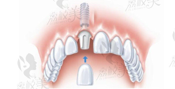 种植牙3D种植过程图