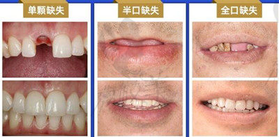 上海雅悦齿科种植牙图