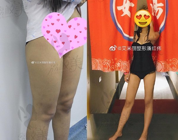 潘宏伟大腿吸脂效果对比