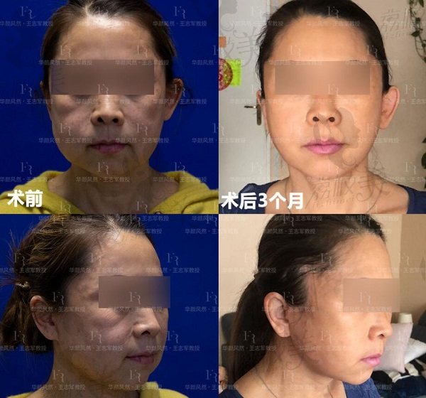王志军教授高位SMAS除皱术术后三个月效果对比