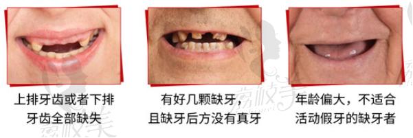 长沙德韩口腔数字化种植牙，半口半固定修复种植仅需9999元！