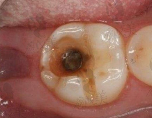 补牙价格为什么差距那么大？复合树脂补牙有哪些优缺点？