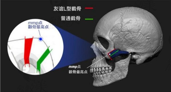 四川友谊张立天L型截骨