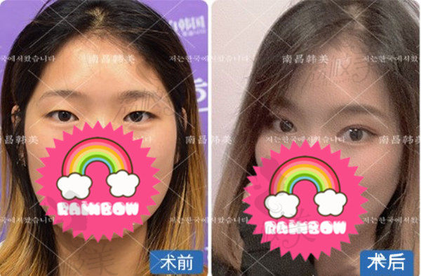 南昌韩美陈丹丹双眼皮术后效果