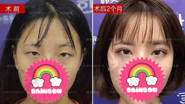 南昌韩美陈丹丹双眼皮效果