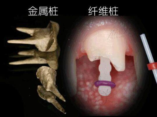 金属桩和纤维桩的区别