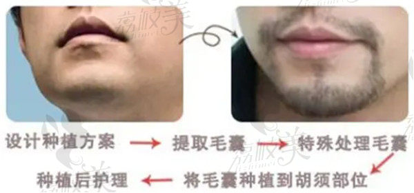 胡子种植过程
