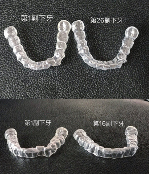 从1副牙套到26副牙套下牙套