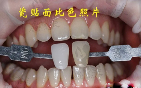 瓷贴面比色