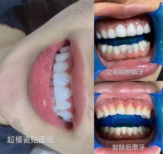瓷贴面效果图
