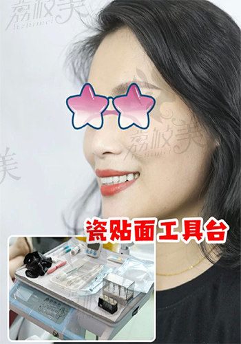 瓷贴面效果