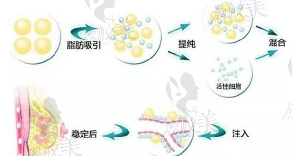 自體脂肪填充胸部步驟