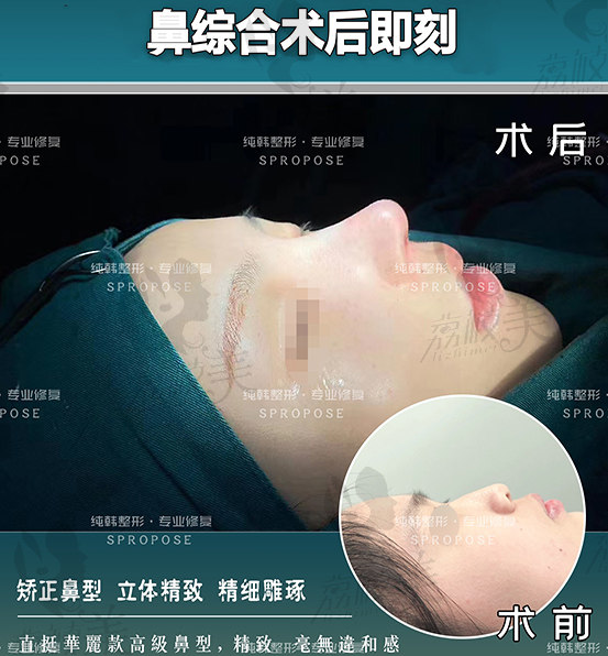 鼻综合手术效果图 