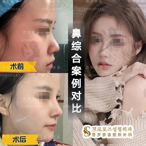 鼻综合手术效果图 