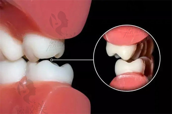 牙齿的牙合力