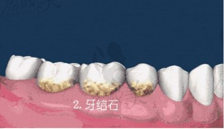 洗牙可以预防龋齿、牙结石