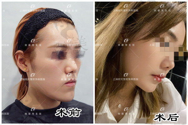 上海时光何晋龙地包天矫正术后效果