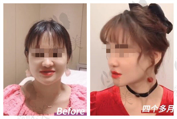 上海时光何晋龙地包天矫正术后效果
