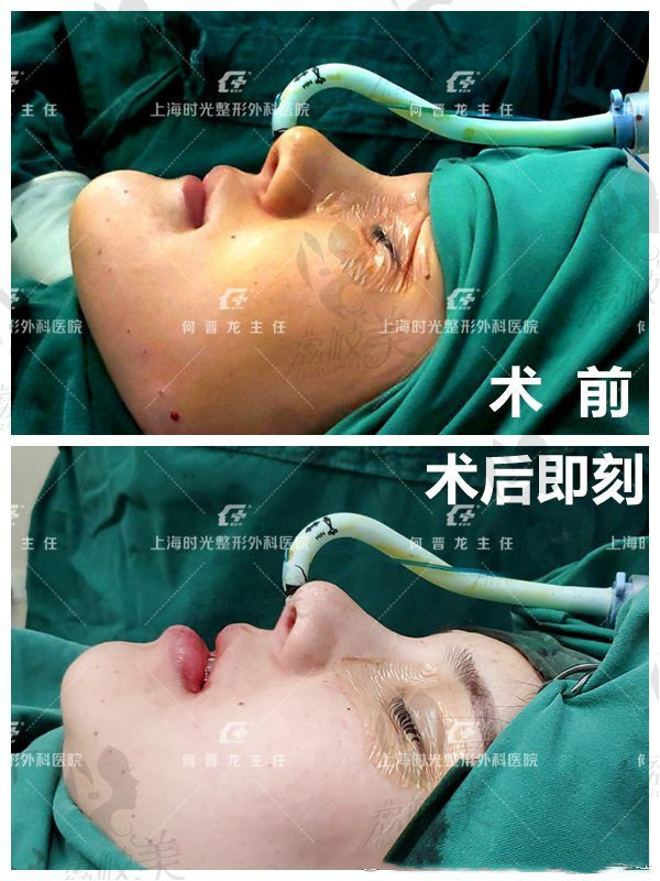 上海时光何晋龙地包天矫正术后效果