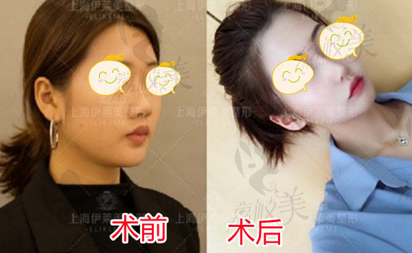 上海伊莱美邱文苑隆鼻对比图