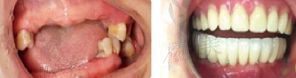 深圳吉华登特口腔半口种植牙对比