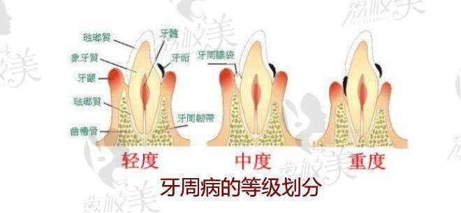 牙周病的等级划分