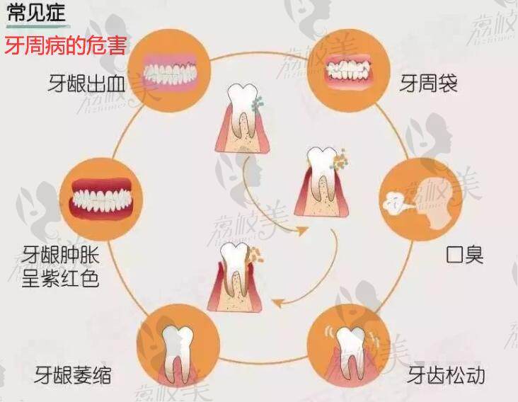 牙周病的危害有什么