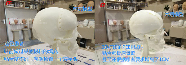 上海时光何晋龙做头颅填充术前术后对比